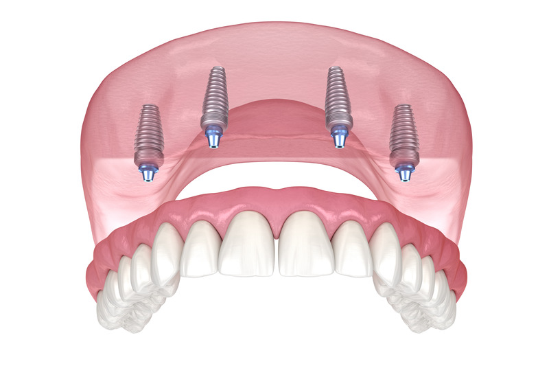 Dental Treatments in Monroe